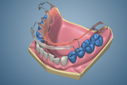 Disking of Teeth (Removable Appliance)